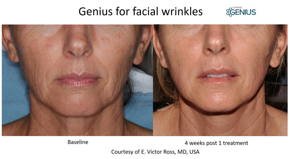 Genius Rf Microneedling Simply Skin Medical Spa