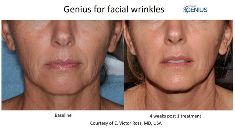 Genius_Ross-Facial-Wrinkles