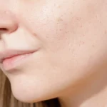 Read more about the article Rebuilding Your Skin’s Foundation: Microneedling for Scars and Texture