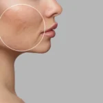 Read more about the article Fading Summer’s Mark: Your Options for Treating Hyperpigmentation