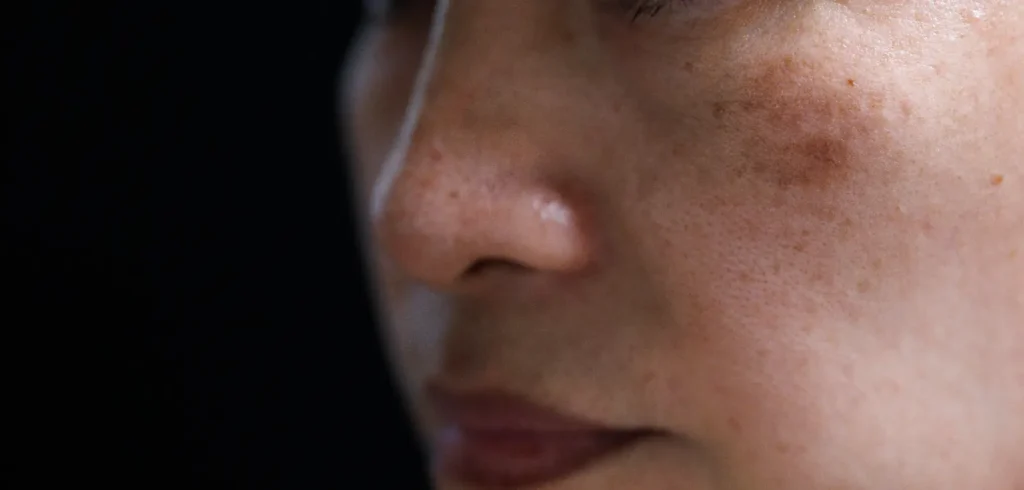 Close-up of a person's cheek and nose showing uneven skin tone, freckles, and visible pigmentation.