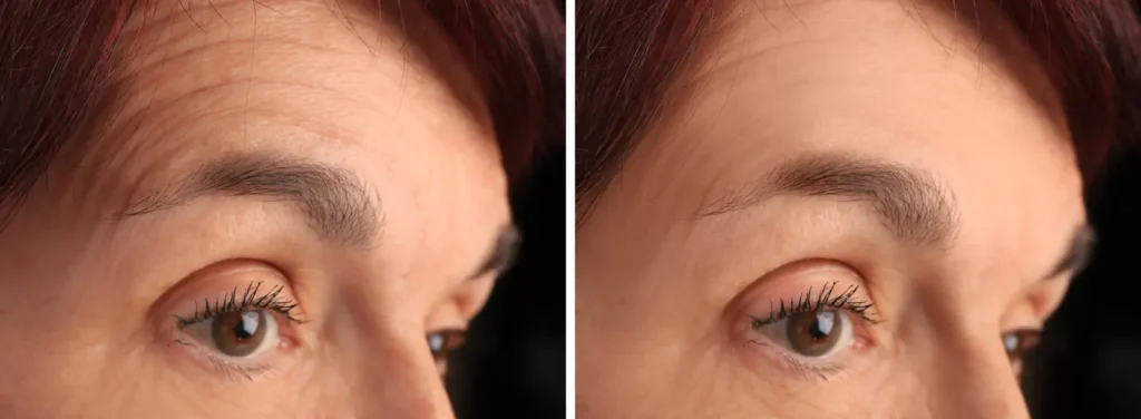 Left and right images show a forehead with visible horizontal lines and differences in line visibility and skin texture.